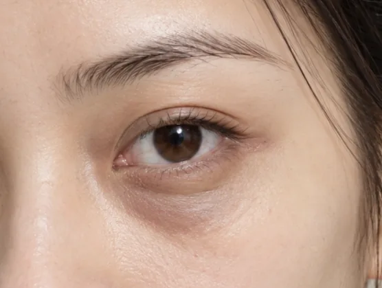 Close-up of an eye with under-eye shadowing
