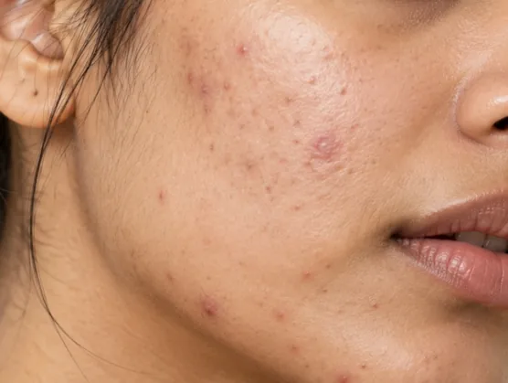 Cheek with active acne and post-acne marks