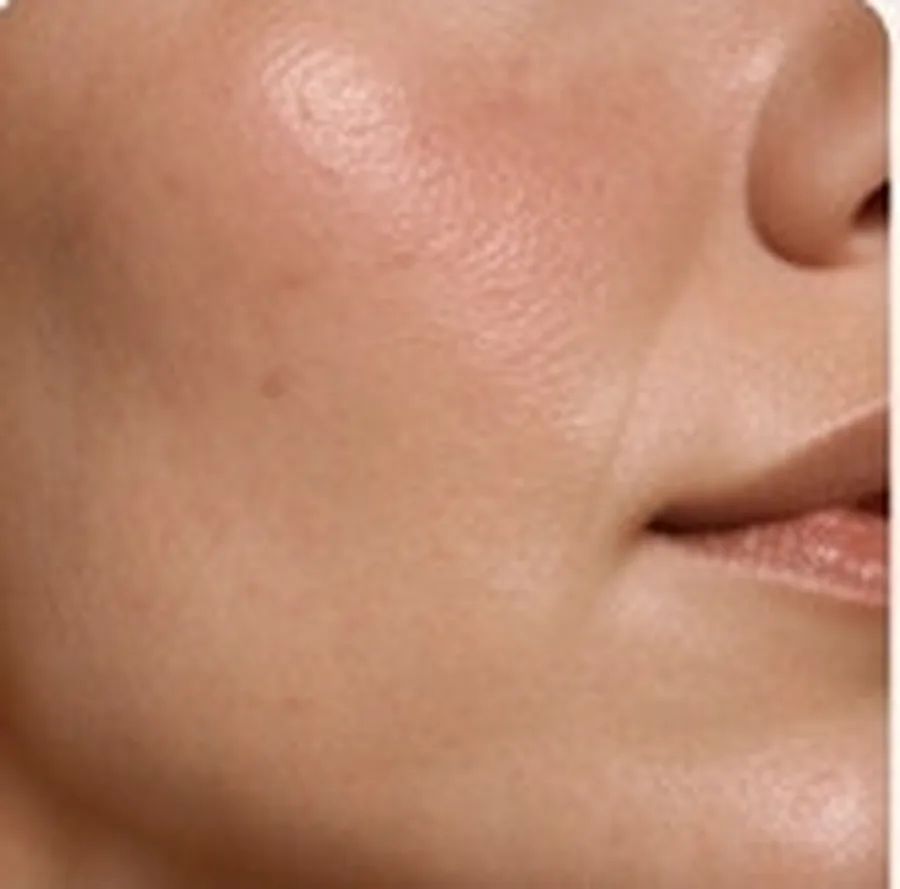Close-up of skin during a treatment